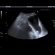 Acute cholecystitis, pericholecystitic abscess: US - Ultrasound