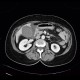 Acute cholecystitis on CT: CT - Computed tomography