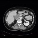 Acute cholecystitis on CT: CT - Computed tomography