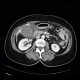 Acute cholecystitis on CT: CT - Computed tomography