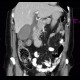 Acute cholecystitis on CT: CT - Computed tomography