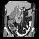 Acute cholecystitis on CT: CT - Computed tomography