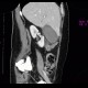 Acute cholecystitis on CT: CT - Computed tomography