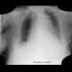 Aortic dissection, Stanford A, hemopericard: X-ray - Plain radiograph