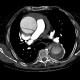 Aortic dissection, Stanford A, hemopericard: CT - Computed tomography
