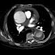 Aortic dissection, Stanford A, hemopericard: CT - Computed tomography