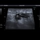 Acute diverticulitis, peridiverticulitis, sigmoid colon: US - Ultrasound