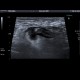 Acute diverticulitis, peridiverticulitis, sigmoid colon: US - Ultrasound