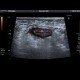 Acute diverticulitis, peridiverticulitis, sigmoid colon: US - Ultrasound