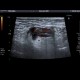 Acute diverticulitis, peridiverticulitis, sigmoid colon: US - Ultrasound