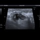 Acute diverticulitis, peridiverticulitis, sigmoid colon: US - Ultrasound