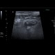 Acute diverticulitis on ultrasound: US - Ultrasound