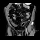 Acute diverticulitis, perforation, peritonitis, pneumoperitoneum: CT - Computed tomography