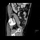 Acute diverticulitis, perforation, peritonitis, pneumoperitoneum: CT - Computed tomography