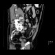 Acute diverticulitis, perforation, peritonitis, pneumoperitoneum: CT - Computed tomography