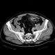 Acute diverticulitis, perforation, peritonitis, pneumoperitoneum: CT - Computed tomography