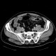 Acute diverticulitis, perforation, peritonitis, pneumoperitoneum: CT - Computed tomography