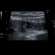 Acute enteritis, enteritis, edema of the valvulae conniventes: US - Ultrasound