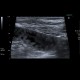 Acute enteritis, enteritis, edema of the valvulae conniventes: US - Ultrasound