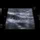 Acute enteritis, enteritis, edema of the valvulae conniventes: US - Ultrasound