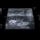 Acute enteritis, enteritis, edema of the valvulae conniventes: US - Ultrasound