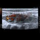 Acute enteritis, enteritis, edema of the valvulae conniventes: US - Ultrasound