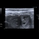 Acute enteritis, enteritis, edema of the valvulae conniventes: US - Ultrasound