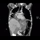 Acute pancreatitis, mediastinitis: CT - Computed tomography