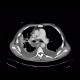 Acute pancreatitis, mediastinitis: CT - Computed tomography