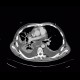 Acute pancreatitis, mediastinitis: CT - Computed tomography