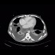 Acute pancreatitis, mediastinitis: CT - Computed tomography