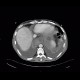 Acute pancreatitis, mediastinitis: CT - Computed tomography