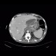 Acute pancreatitis, mediastinitis: CT - Computed tomography