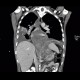 Acute pancreatitis, mediastinitis: CT - Computed tomography