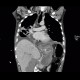 Acute pancreatitis, mediastinitis: CT - Computed tomography