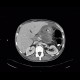 Acute pancreatitis, mediastinitis: CT - Computed tomography