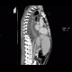 Acute pancreatitis, mediastinitis: CT - Computed tomography