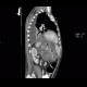 Acute pancreatitis, mediastinitis: CT - Computed tomography