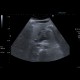 Acute pancreatitis on ultrasound: US - Ultrasound