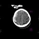 Acute subdural hemorrhage, active bleeding: CT - Computed tomography