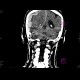 Acute subdural hemorrhage, active bleeding: CT - Computed tomography
