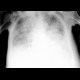 Alveolar lung edema: X-ray - Plain radiograph