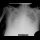 Alveolar pulmonary edema: X-ray - Plain radiograph