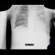 Intra-alveolar hemorrhage: X-ray - Plain radiograph