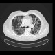 Amiodarone lung, toxic pneumonitis: CT - Computed tomography