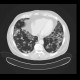 Amiodarone lung, toxic pneumonitis: CT - Computed tomography