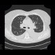 Pulmonary amyloidosis, diffuse parenchymal form: CT - Computed tomography