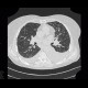 Pulmonary amyloidosis, diffuse parenchymal form: CT - Computed tomography