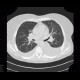 Pulmonary amyloidosis, diffuse parenchymal form: CT - Computed tomography