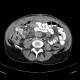 Anaplastic lymphoma in peritoneal cavity, retroperitoneal and mesenterial lymphadenopathy: CT - Computed tomography